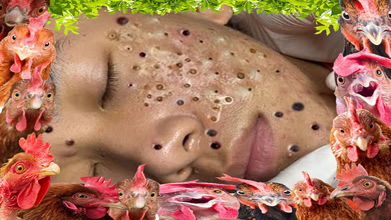 Blackheads Removal!